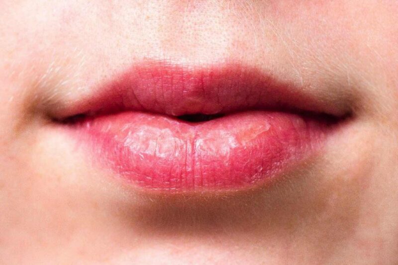 Tipps trockene und rissige Lippen